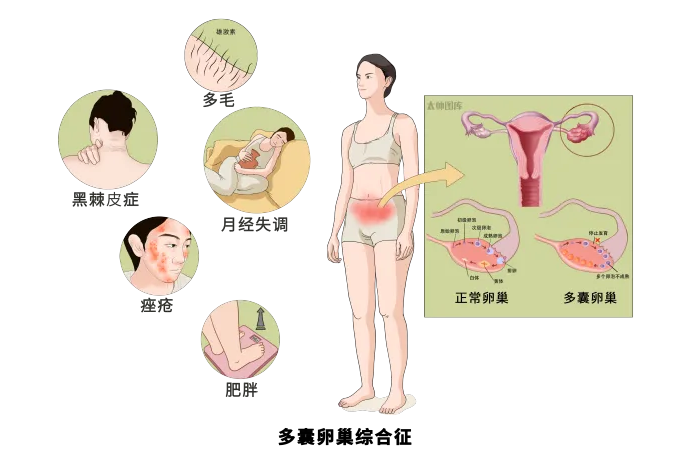 多囊卵巢什么会导致不孕不育？