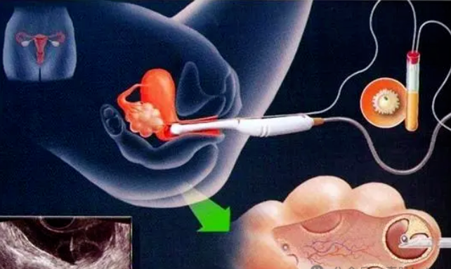 胚胎移植方案选择|试管移植前女性需要做哪些准备?（试管备孕）